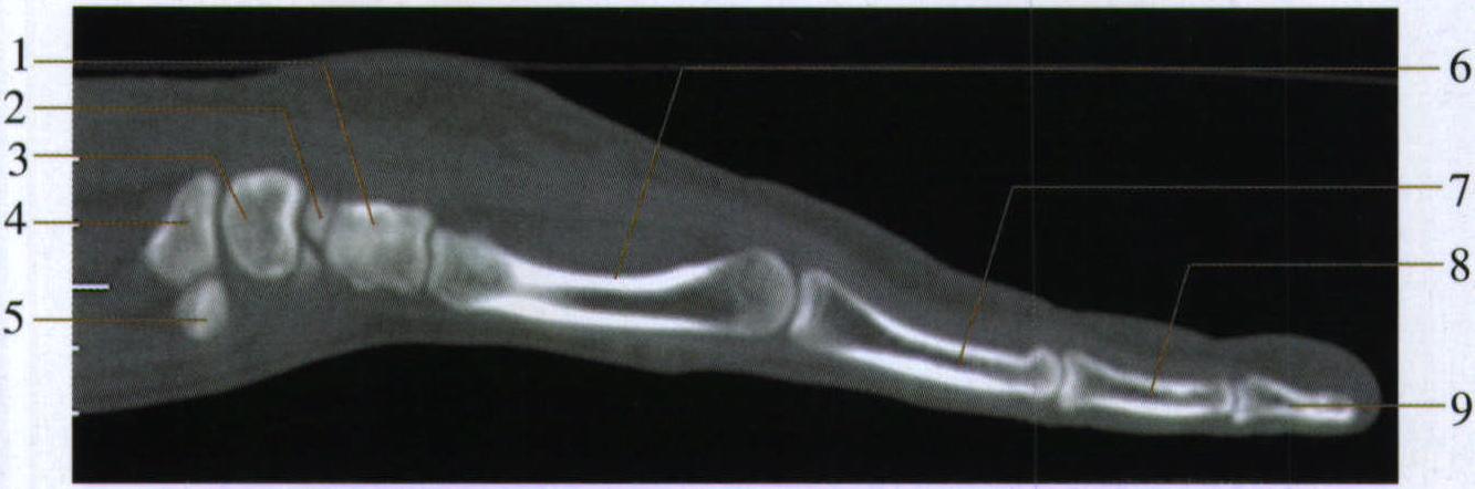 图8-53 CT环指、第4掌骨、腕骨矢状面断层骨窗